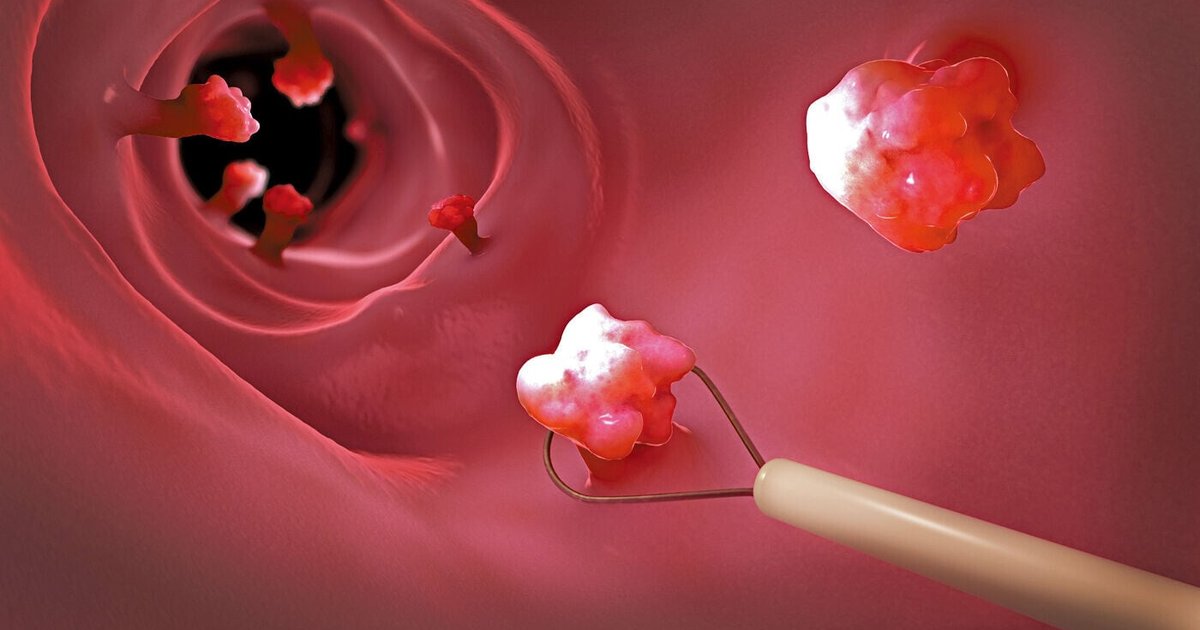 Most Gastric Polyps Benign with Low Cancer Risk, Regular Monitoring Advised