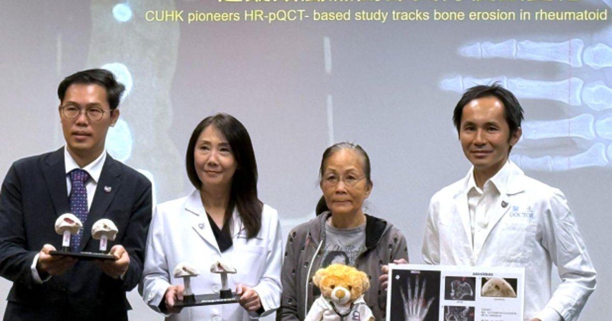 中大首創電腦掃瞄技術追蹤類風濕關節炎骨侵蝕變化助及早治療
