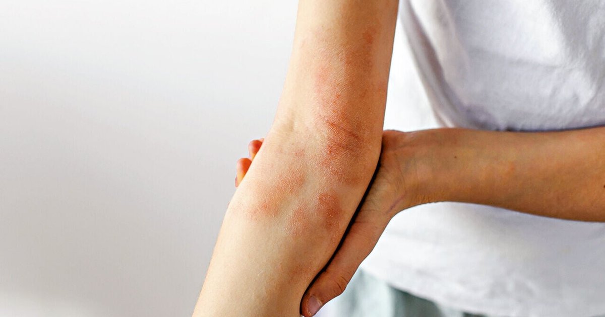 Eczema group urges review of advanced treatment access