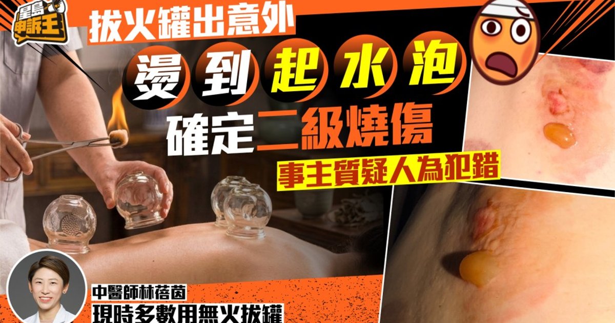 中醫診所拔罐治療出事 事主二級燒傷需清洗傷口兩星期