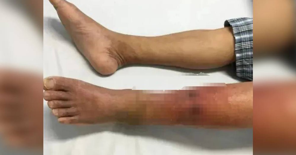 深圳二百磅男子狂搔腳致嚴重紅腫 醫生揭開「指尖隱形殺手」真面目