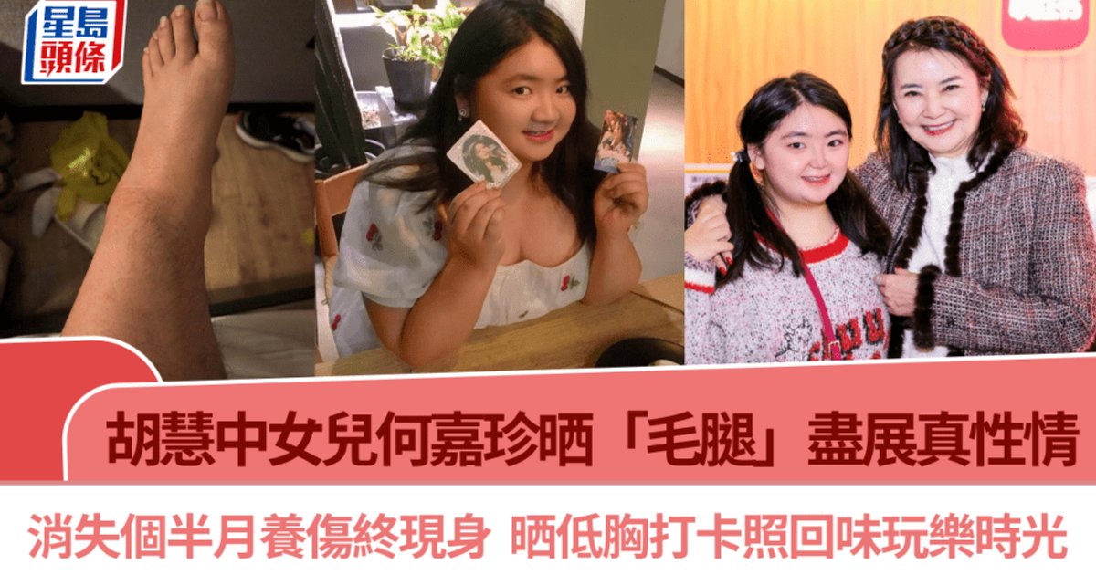 胡慧中24岁女儿何嘉珍骨折后首现身 大方晒“毛腿”展率真性格