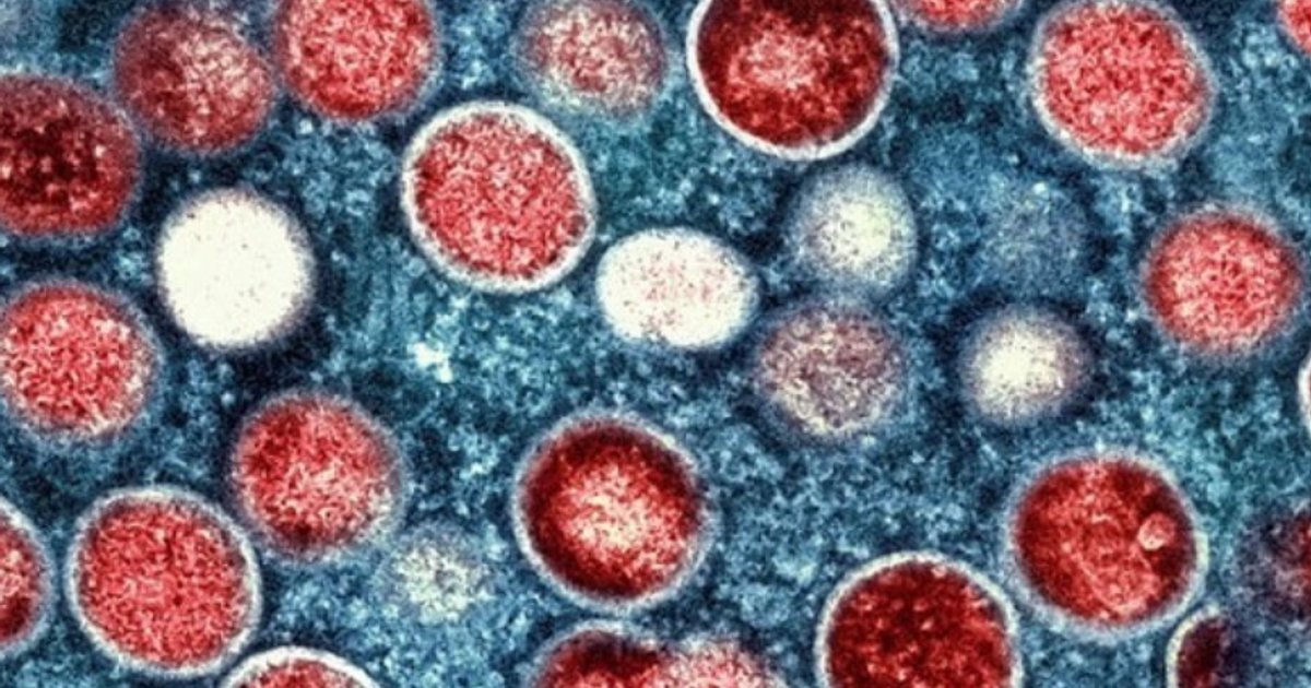 Hong Kong Records New Imported Mpox Case; 40-Year-Old Man Hospitalized in Stable Condition