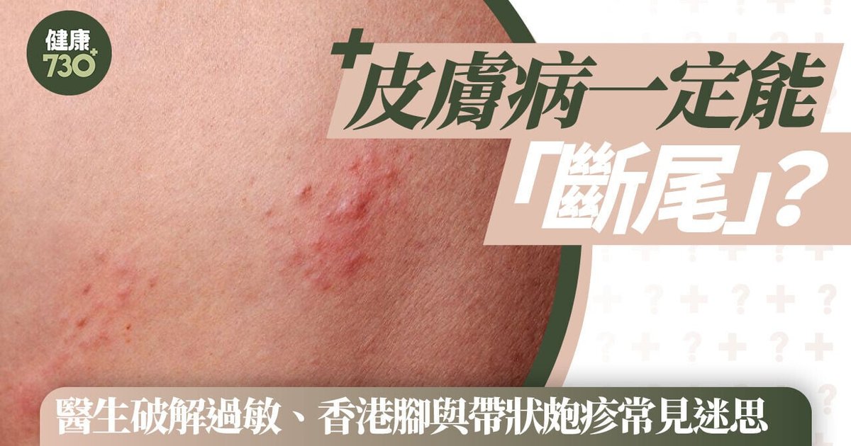 皮肤病一定能「断尾」？医生破解过敏、脚气与带状疱疹常见迷思