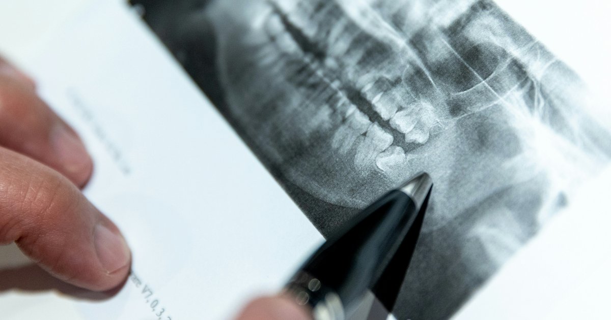 Shenzhen Dentists Push Urgent Extractions Near Nerve Lines; HK Professional Body Warns of Risks