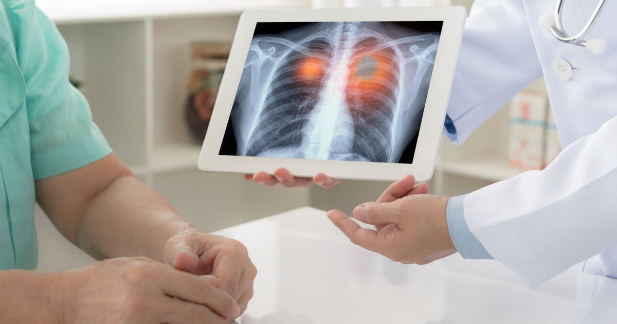 Survey: 63% of ALK Lung Cancer Patients Pay Over HK$10,000 Monthly Out-of-Pocket