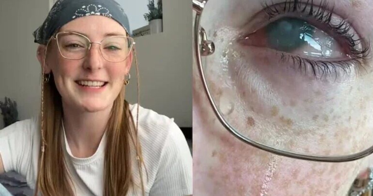 US Woman Nearly Blinded After Showering with Contact Lenses