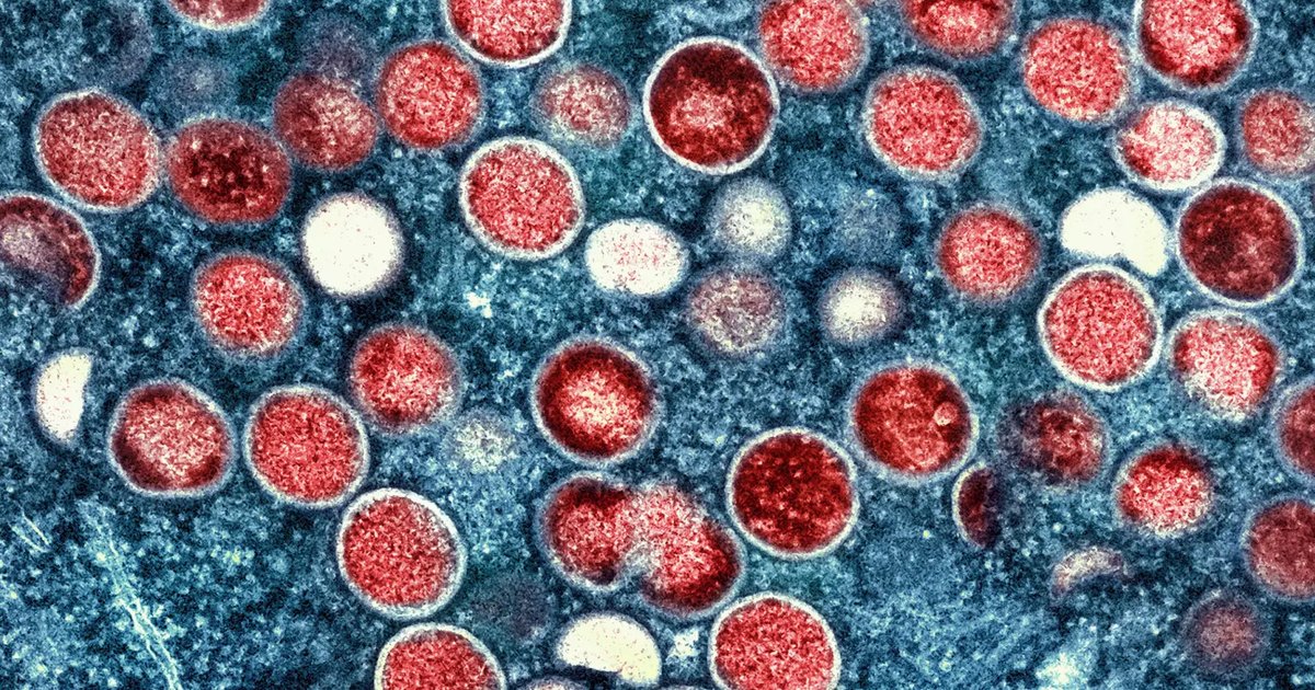 Russia probes suspected mpox cluster in Moscow region