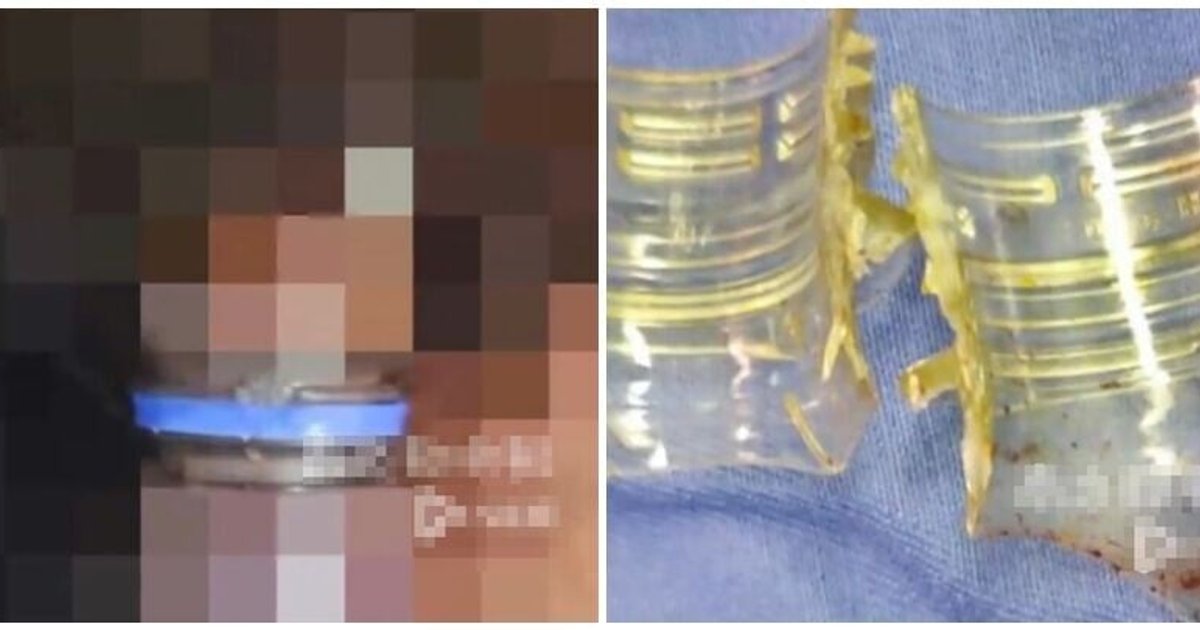 Zhejiang Man Hospitalized After Coke Bottle Gets Stuck on Private Parts